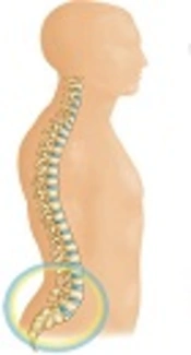 Frequency Evaluation of Early Pregnancy in Spondylolisthesis: A Cross Sectional Study on Iranian Females